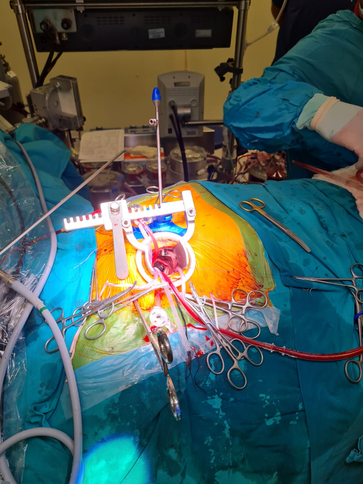 KSÜ Tıp Fakültesi Hastanesi Minimal İnvaziv Kalp Cerrahisinde Endoskopik Kalp Ameliyatlarına Başlandı